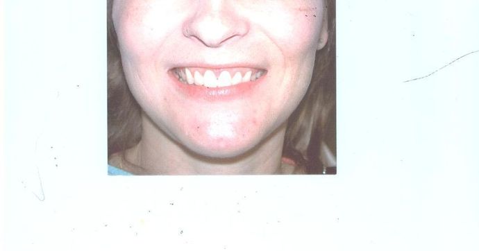 Gum Lift Case 2 - After