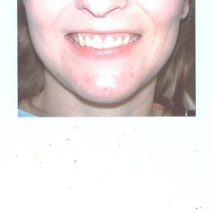 Gum Lift: Case 2 - Before