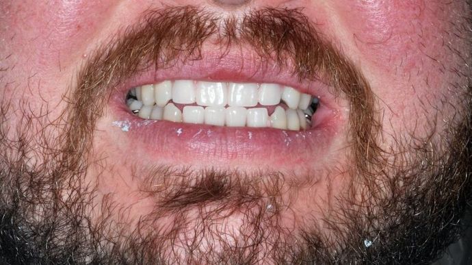 Dental Crowns Case 23 - After