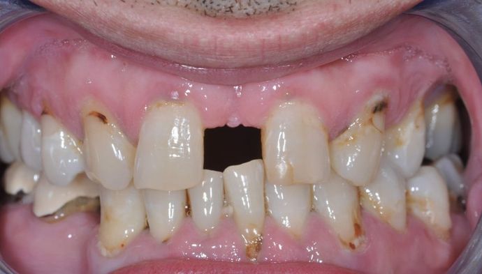 Dental Crowns Case 23 - Before