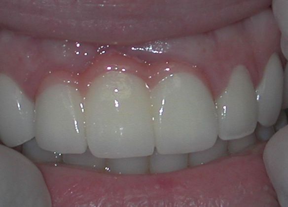 Dental Crowns Case 24 - Before