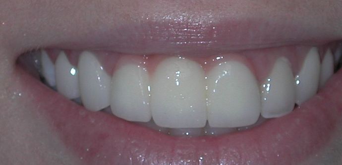 Dental Crowns Case 24 - After