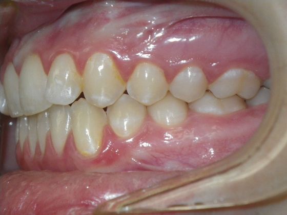 Invisalign: Case 10 - Before