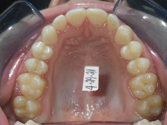 Invisalign: Case 10 - After