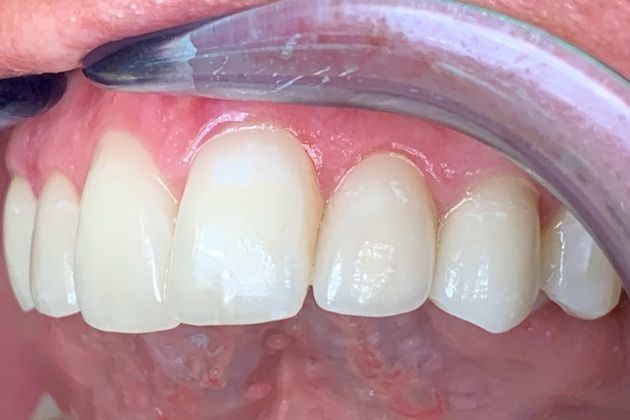 Cosmetic Dentistry: Ceramic Dental Veneers-Not just for the whole arch! - After