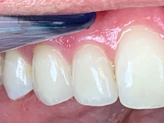 Cosmetic Dentistry: Ceramic Dental Veneers-Not just for the whole arch! - After