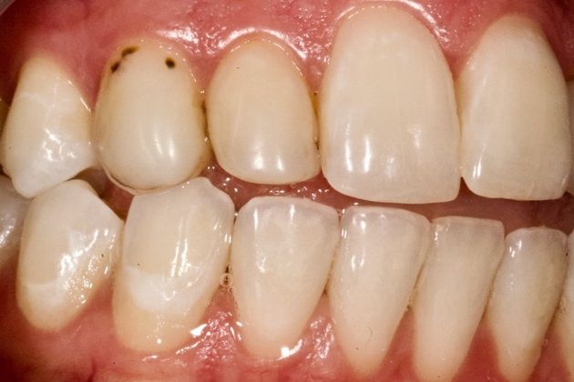 Cosmetic Dentistry: Ceramic Dental Veneers-Not just for the whole arch! - Before