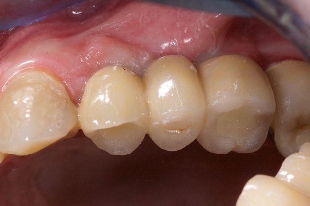 A Basket of Different Dental Implant Cases Cases