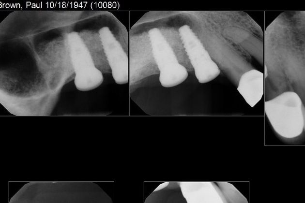 A Basket of Different Dental Implant Cases: Orphan Dental Implant Cases Need Homes Too - Before