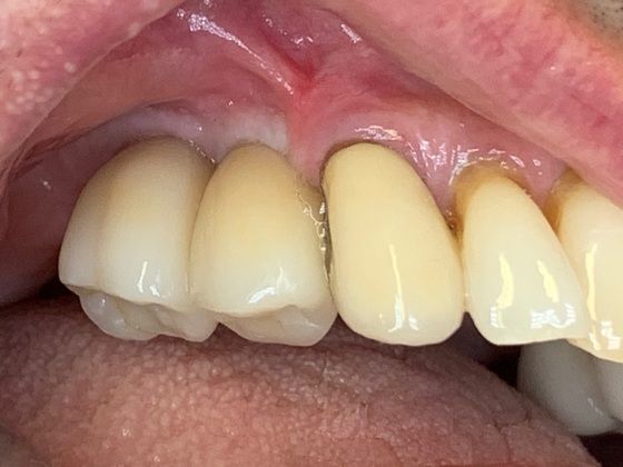 A Basket of Different Dental Implant Cases: Orphan Dental Implant Cases Need Homes Too - After