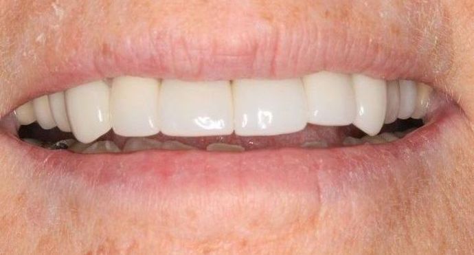 Full Mouth Reconstruction Case 12 - Before