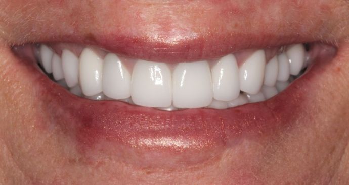 Full Mouth Reconstruction Case 12 - After