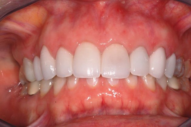 Cosmetic Dentistry: Full Arch Porcelain Veneers-A Real Makeover - After