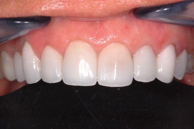Cosmetic Dentistry: Full Arch Porcelain Veneers-A Real Makeover - After