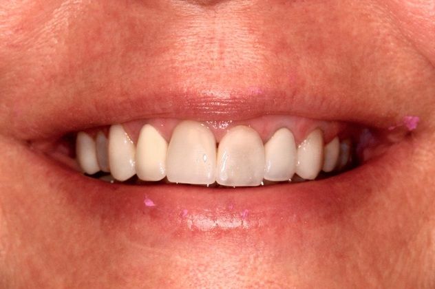Cosmetic Dentistry: Full Arch Porcelain Veneers-A Real Makeover - Before