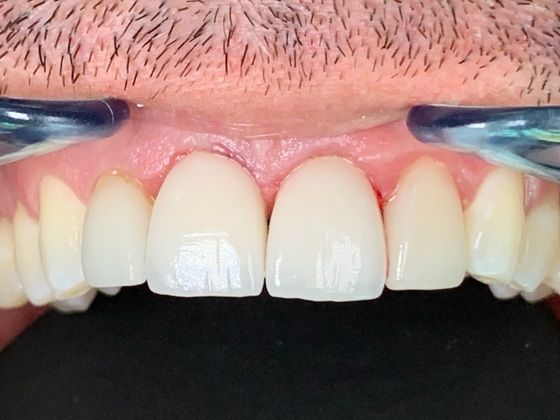 A Basket of Different Dental Implant Cases: External Resorption of Anterior Tooth Roots - After