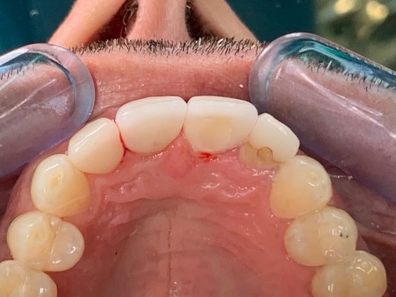 A Basket of Different Dental Implant Cases: External Resorption of Anterior Tooth Roots - After