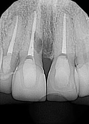 A Basket of Different Dental Implant Cases: External Resorption of Anterior Tooth Roots - Before