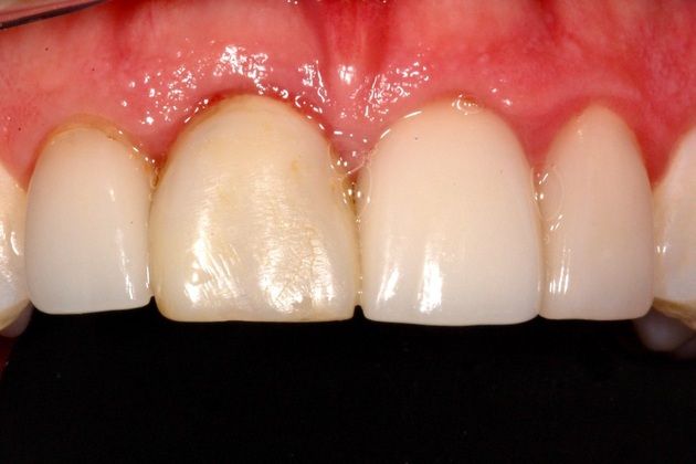 A Basket of Different Dental Implant Cases: External Resorption of Anterior Tooth Roots - Before
