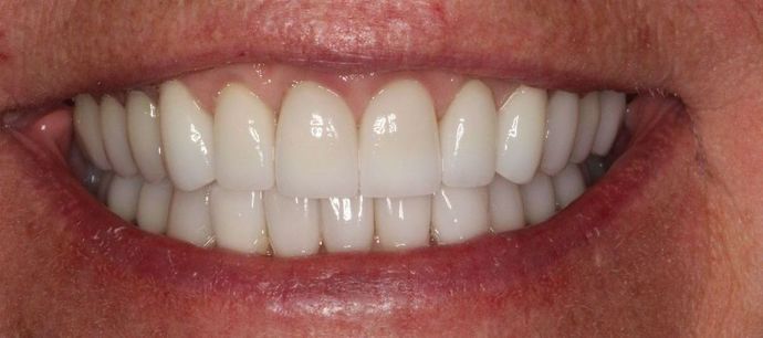 Full Mouth Reconstruction: Case 13 - After