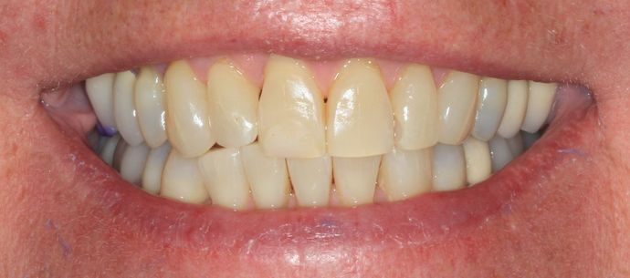 Full Mouth Reconstruction: Case 13 - Before