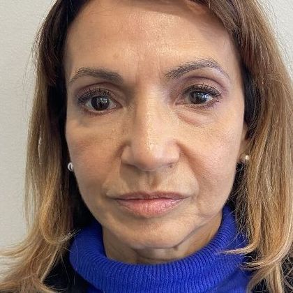 Eyelid Lift: Case 24 Lower Eyelid Lift, Darien - Before