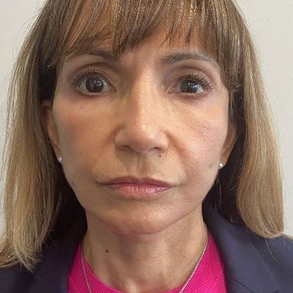 Eyelid Lift: Case 24 Lower Eyelid Lift, Darien - After