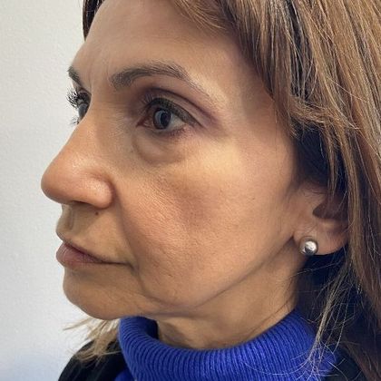 Eyelid Lift: Case 24 Lower Eyelid Lift, Darien - Before