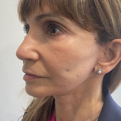 Eyelid Lift: Case 24 Lower Eyelid Lift, Darien - After