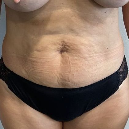 Tummy Tuck: Case 24 Tummy Tuck Lakeville, CT - Before