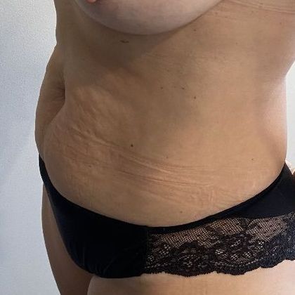 Tummy Tuck: Case 24 Tummy Tuck Lakeville, CT - Before