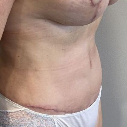 Tummy Tuck: Case 24 Tummy Tuck Lakeville, CT - After