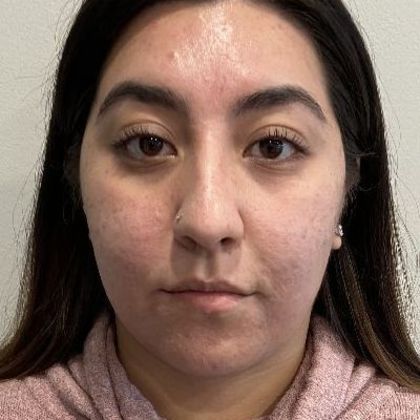 Rhinoplasty: Case 6 - Rhinoplasty, Greenwich - Before