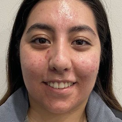 Rhinoplasty: Case 6 - Rhinoplasty, Greenwich - After