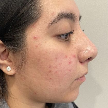 Rhinoplasty: Case 6 - Rhinoplasty, Greenwich - After