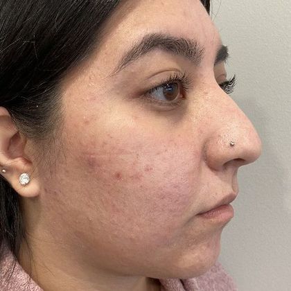 Rhinoplasty: Case 6 - Rhinoplasty, Greenwich - Before