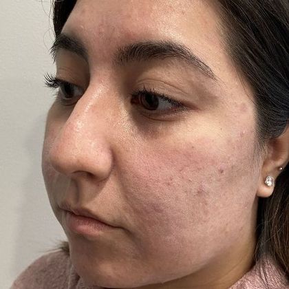 Rhinoplasty: Case 6 - Rhinoplasty, Greenwich - Before