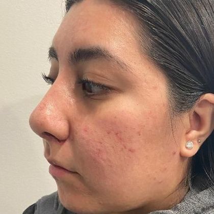 Rhinoplasty: Case 6 - Rhinoplasty, Greenwich - After