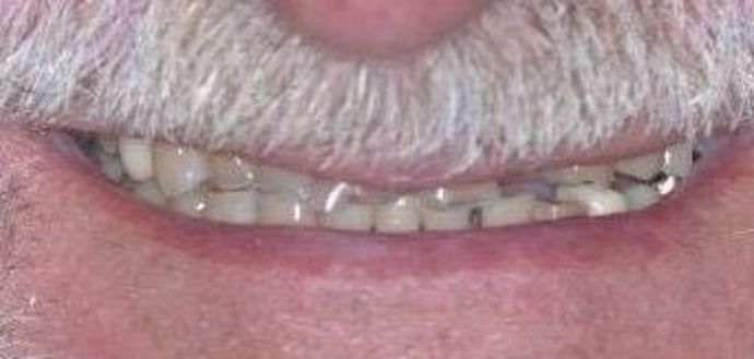 Dental Crowns Case 25 - Before