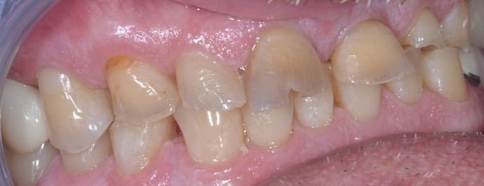 Dental Crowns: Case 25 - Before