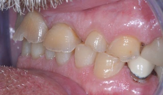 Dental Crowns: Case 25 - Before