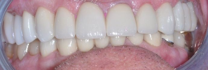 Dental Crowns Case 25 - After