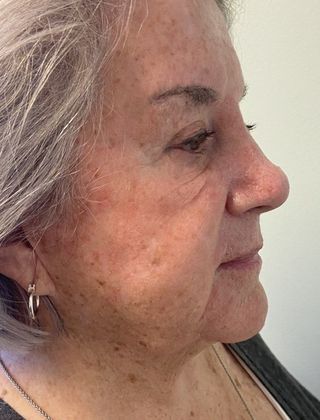 Eyelid Lift: Case 25 Upper Eyelid Lift, Westport, CT - Before