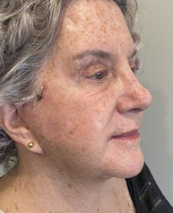 Eyelid Lift: Case 25 Upper Eyelid Lift, Westport, CT - After