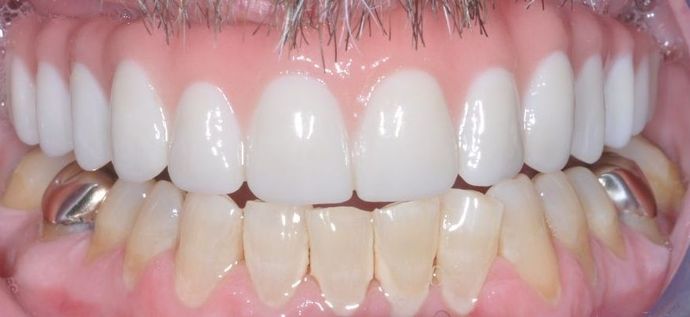 Teeth In A Day: Case 21 - Upper Prosthetic