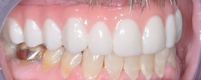 Teeth In A Day: Case 21 - Upper Prosthetic