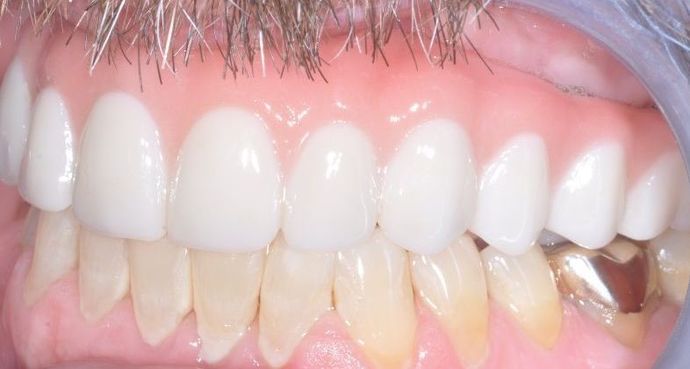 Teeth In A Day: Case 21