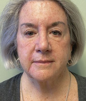 Facelift: Case 28 Face lift and upper eyelid lift, Westport, CT - Before