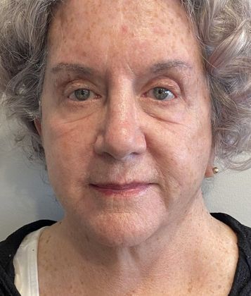 Facelift: Case 28 Face lift and upper eyelid lift, Westport, CT - After