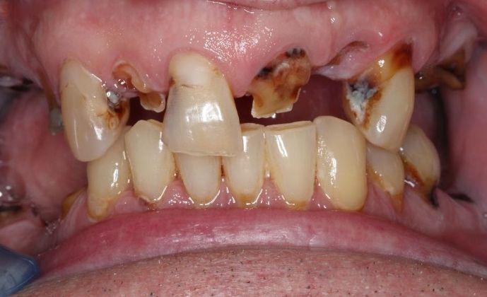 Dentures: Case 3 - Before